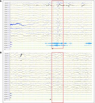 Case Report: Autoimmune encephalitis and other neurological syndromes with rare neuronal surface antibody in children after hematopoietic stem cell transplantation